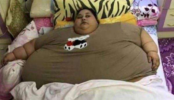 Rare genetic defect cause of Egyptian Eman Ahmed’s obesity
