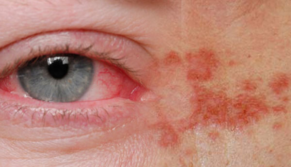 Skin &  Eye Disease Spread Due to Heat Weather  
