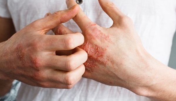 5 Unusual Causes of Eczema & How To Get Relief Naturally