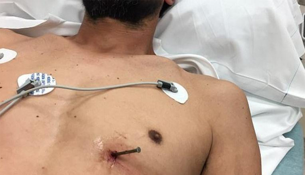 52 year Old Man Appeared in a Hospital with an Accidentally Pierced 3.5 inch Nail Near His Heart