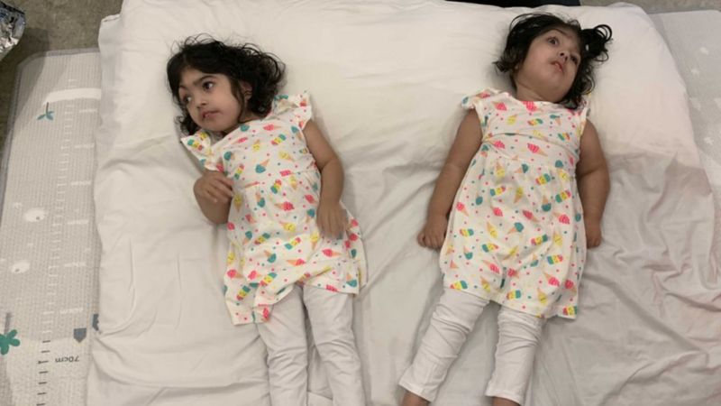 Conjoined twins return home after successful separation