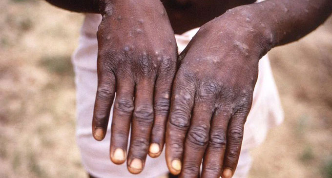 US reports 1st monkeypox case of 2022