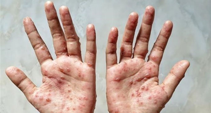 Indonesia announces its first case of monkey pox